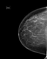 Mammogram film