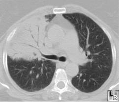 Pneumonia on CT scan